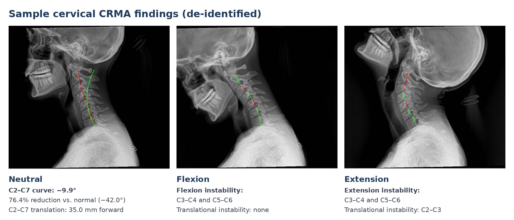 Sample cervical CRMA findings in neutral, flexion and extension